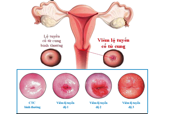 Các giai đoạn của bệnh viêm lộ tuyến cổ tử cung